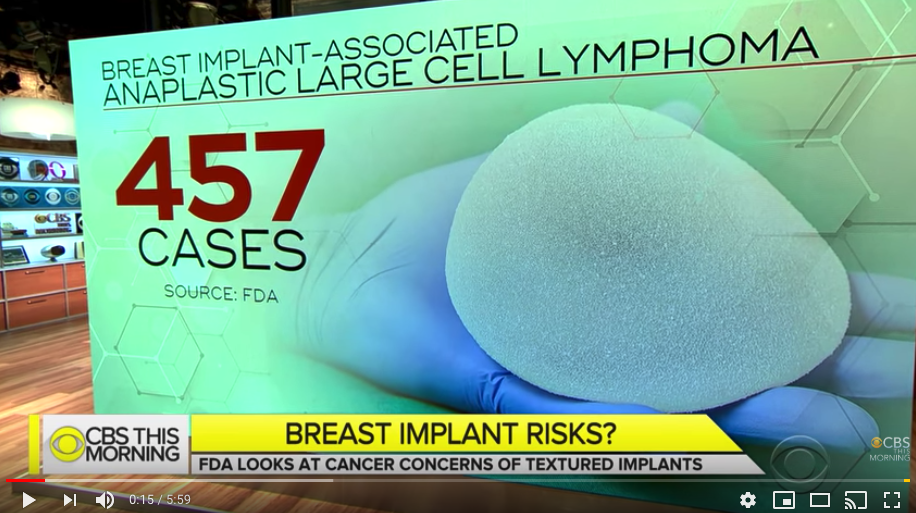 CBS NEWS – FDA weighs possible cancer risks of textured breast implants